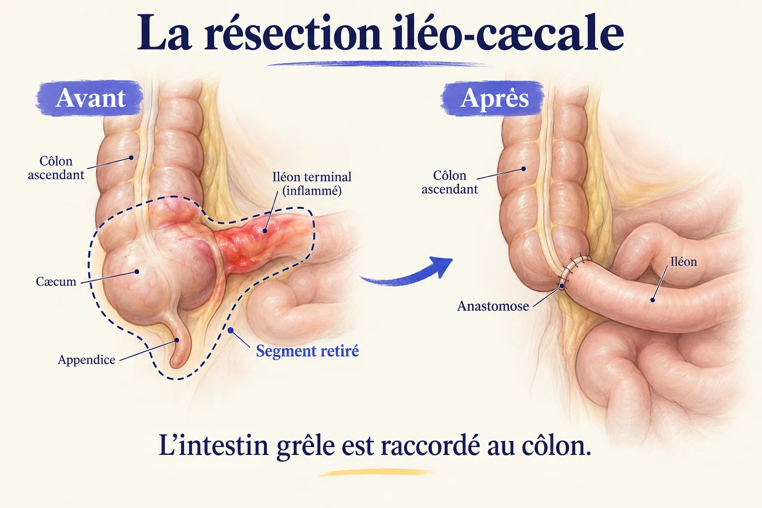Avant/après d'une résection iléo-cæcale : le segment retiré (iléon terminal enflammé, cæcum et appendice) puis l'iléon raccordé au côlon ascendant